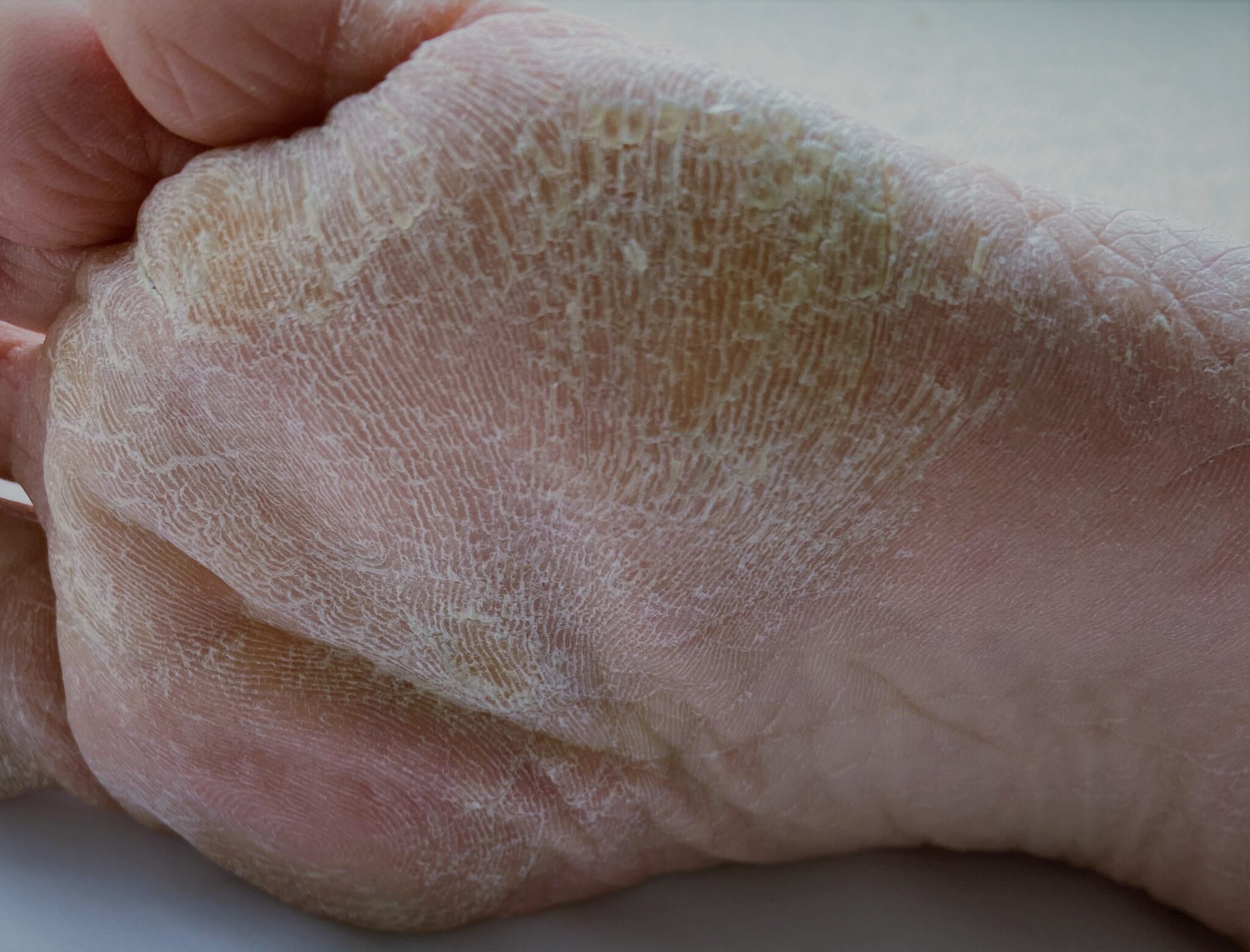 Conditions PodCura Foot Health Clinic West Bridgford